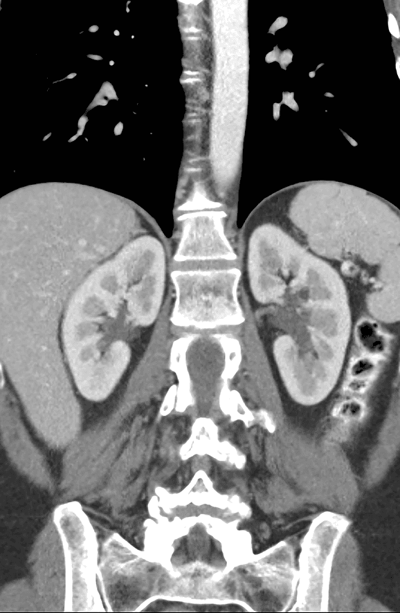 CT-scan van de nieren