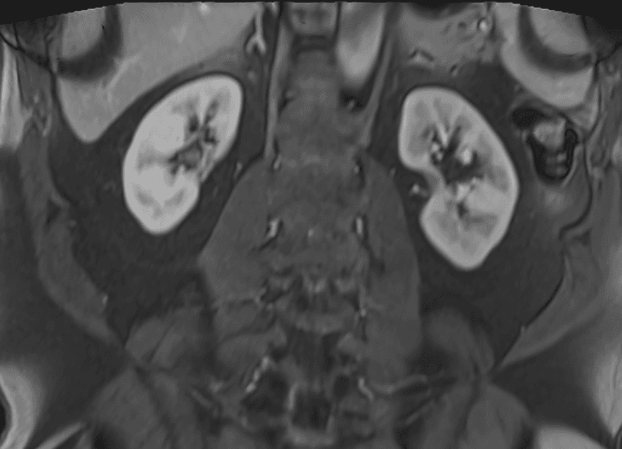 MRI-scan van de nieren