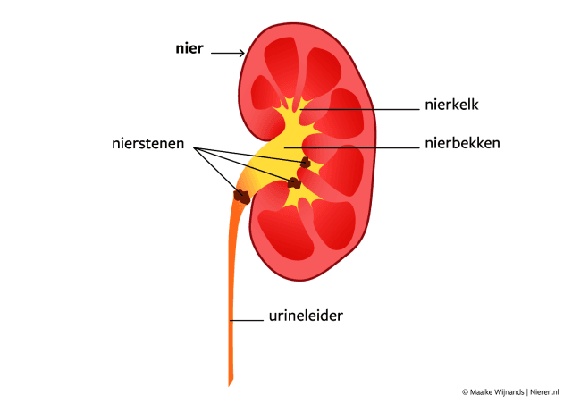 Nierstenen