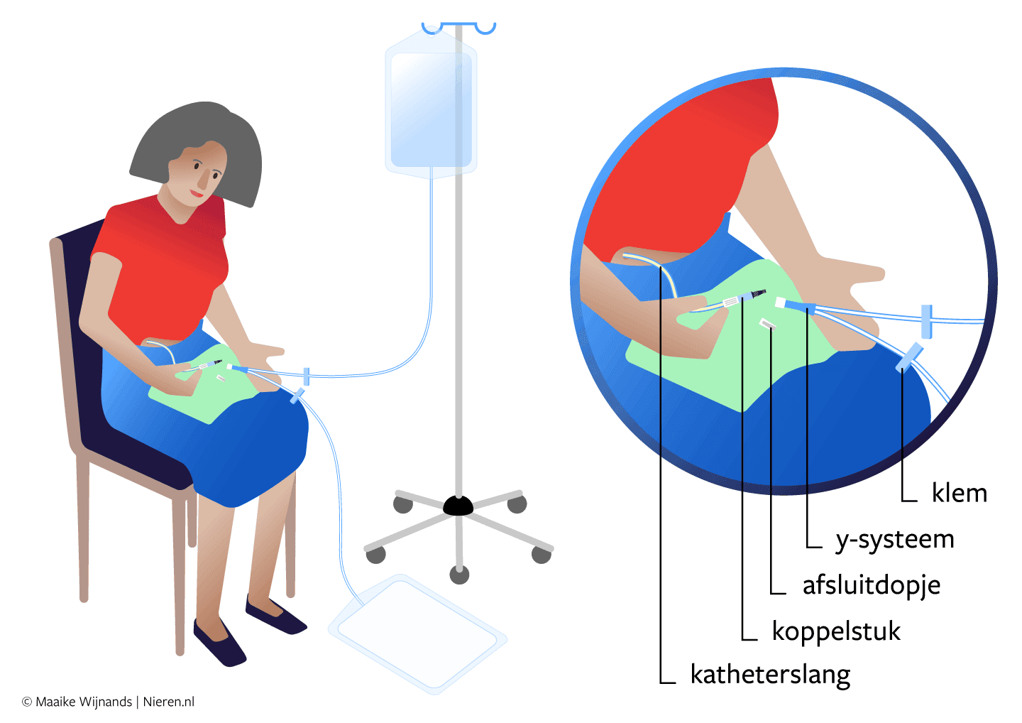 Illustratie van het Y-systeem voor het wisselen van spoelvloeistof bij PD