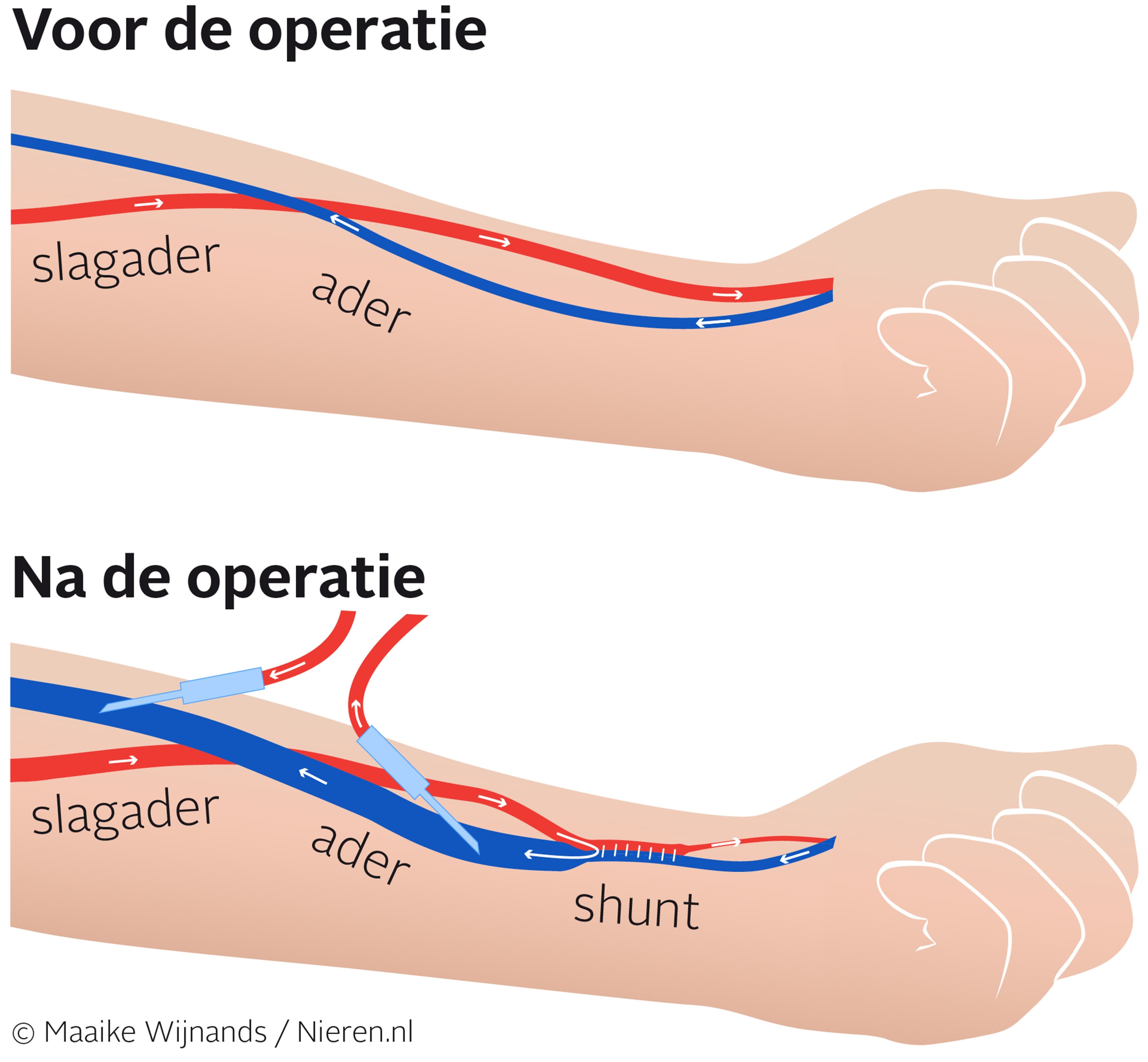 Shunt met eigen bloedvaten voor hemodialyse