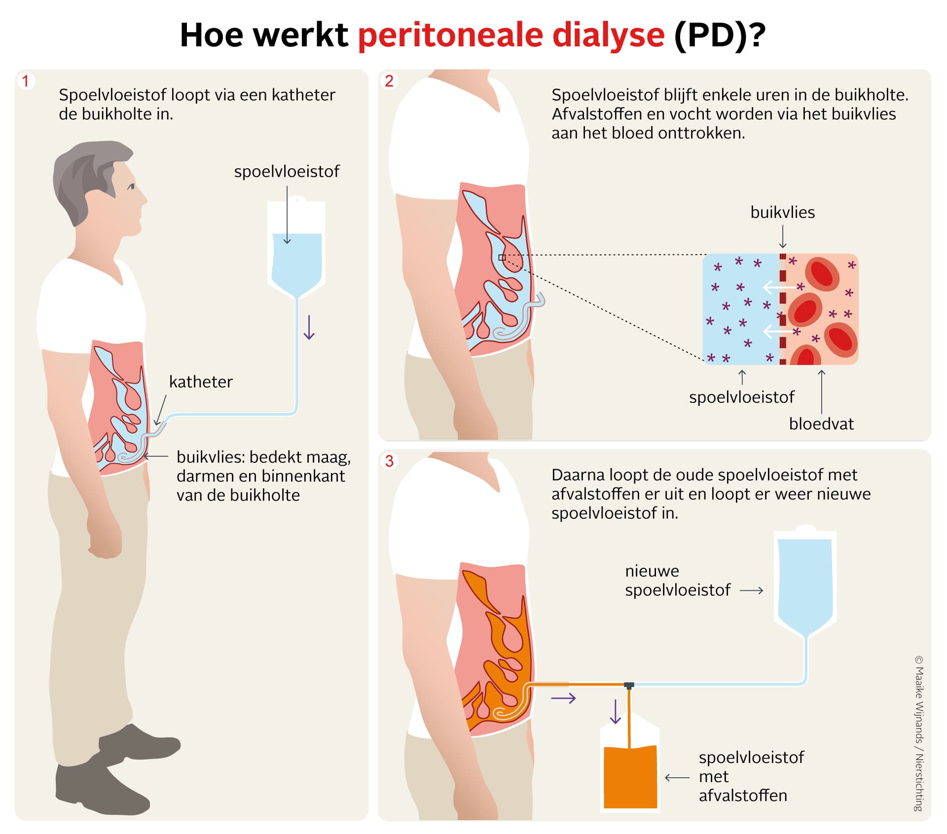 Schematische weergave van hoe peritoneale dialyse werkt.