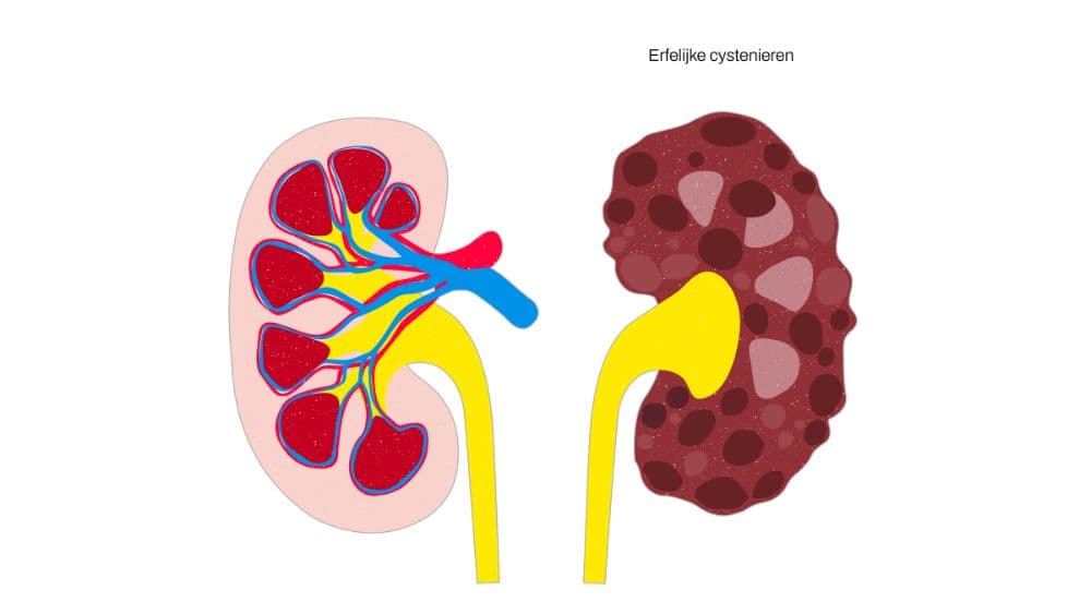 Nier met cystes