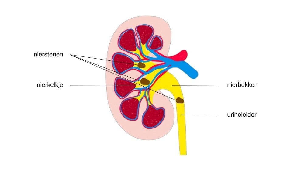 Nierstenen