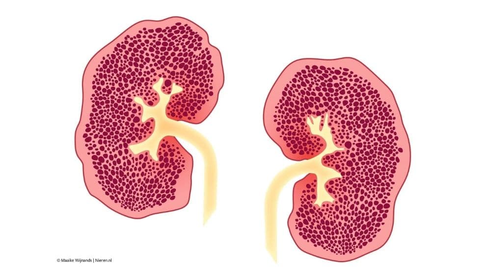 Nier met ARPKD