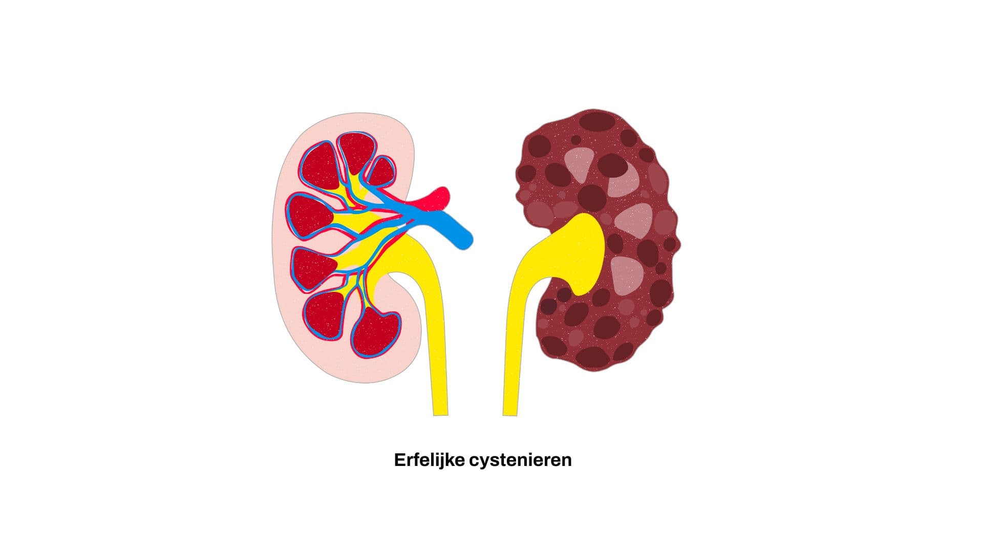 Erfelijke cystenieren